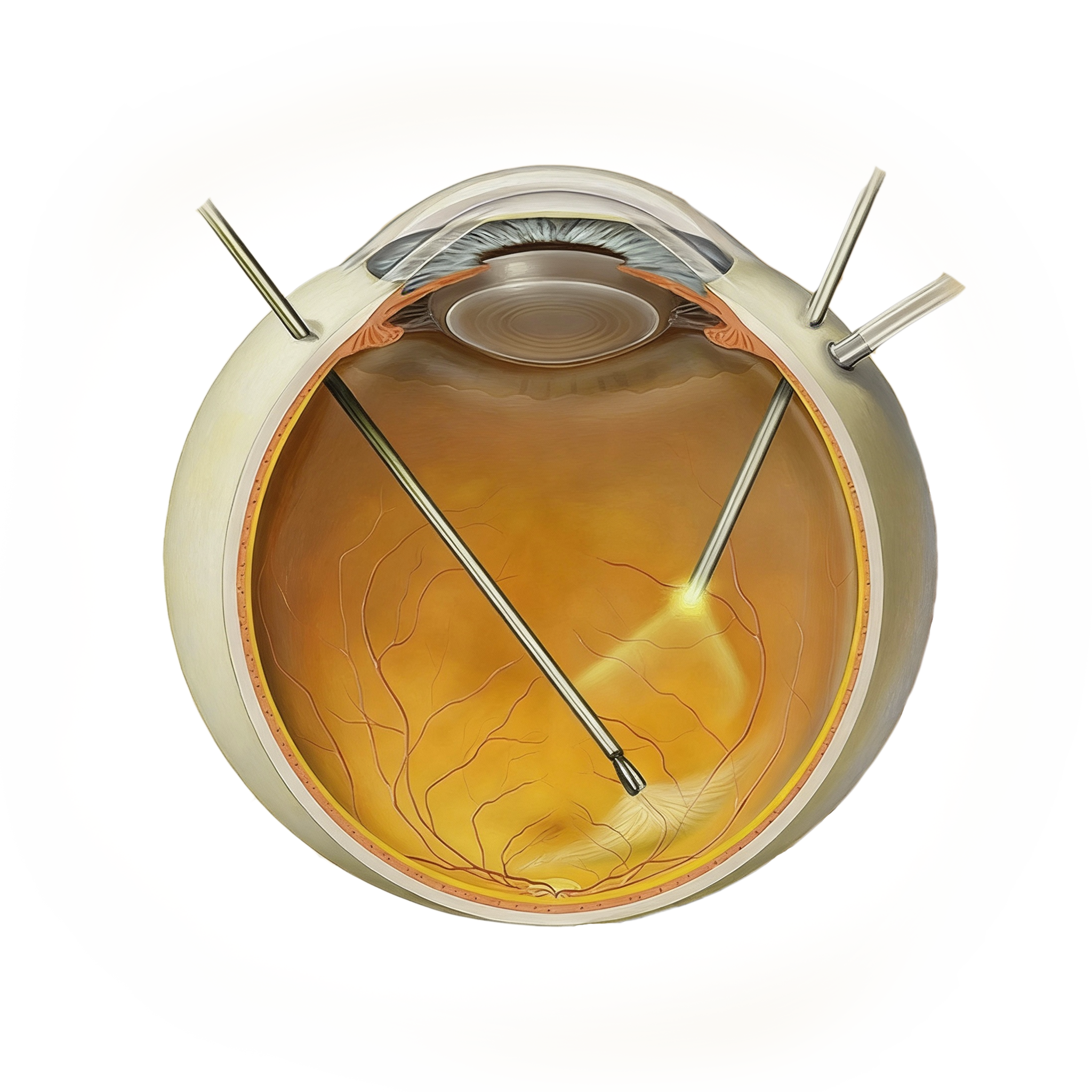 Surgical Training in Vitreoretinal Surgery